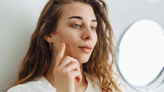 Jak pozbyć się zaskórników? Poradnik krok po kroku