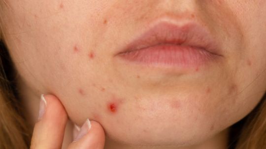 Jak usunąć przebarwienia po trądziku? Poznaj skuteczne sposoby!