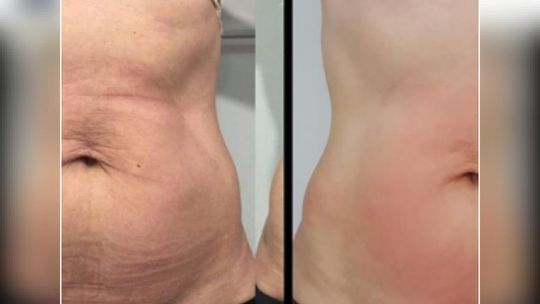 Minus cztery centymetry w tydzień. Czy to możliwe?