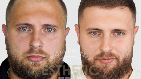 Przeszczep włosów w Turcji – sposób na gęste włosy i pewność siebie Przeszczep włosów w Turcji – sposób na gęste włosy i pewność siebie