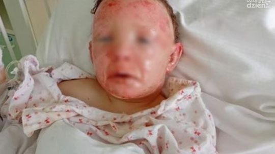 Rodzina spod Szydłowca ranna w pożarze prosi o pomoc