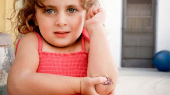 Skąd mam tyle siniaków?