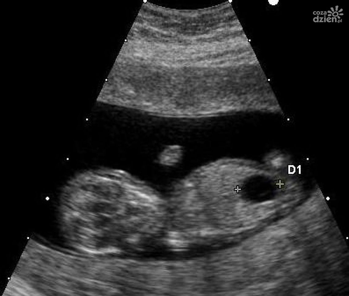 Będzie konferencja „Dotknąć zespół Downa”