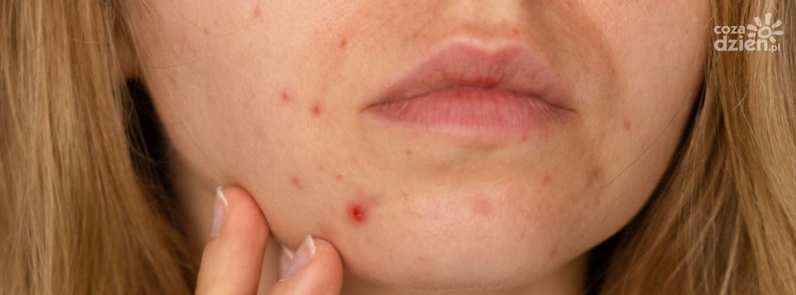 Jak usunąć przebarwienia po trądziku? Poznaj skuteczne sposoby!
