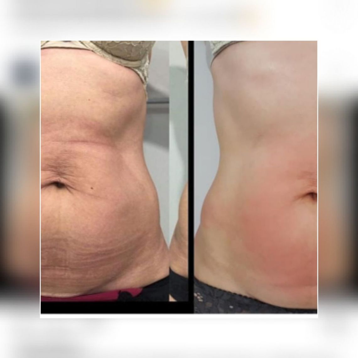 Minus cztery centymetry w tydzień. Czy to możliwe?