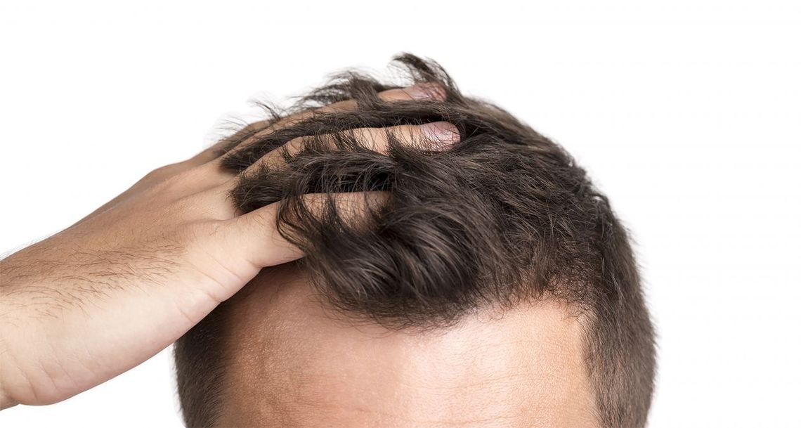 Przeszczep włosów - jak wybrać dobrą klinikę Przeszczep włosów - jak wybrać dobrą klinikę