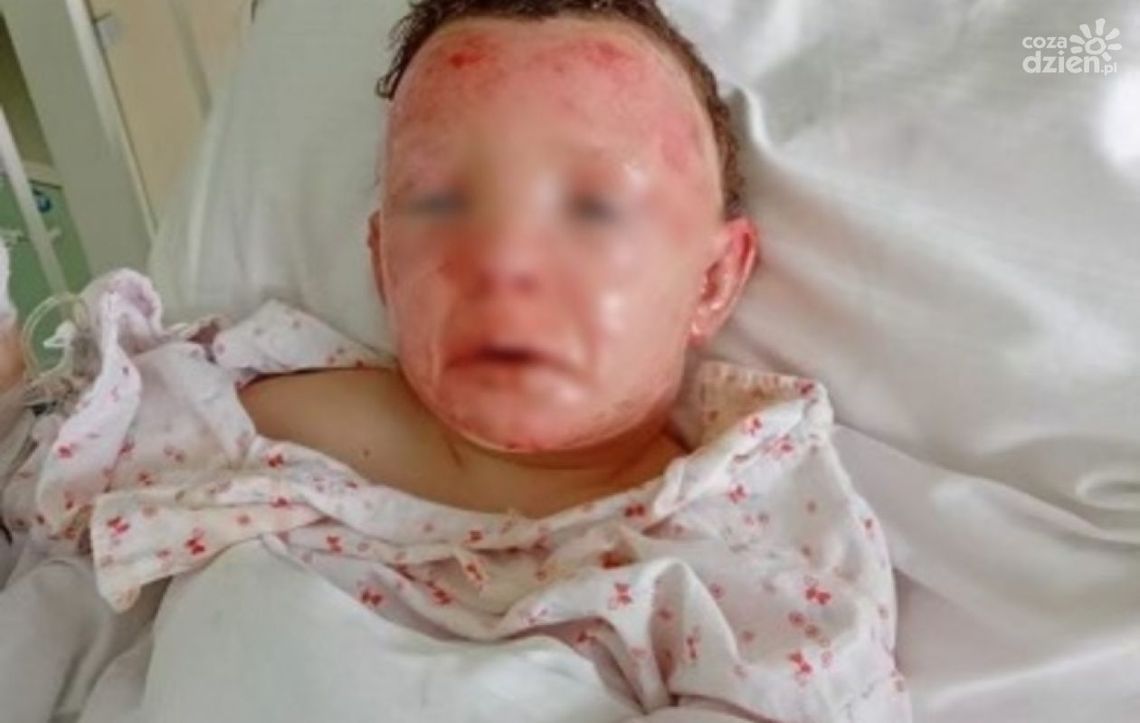 Rodzina spod Szydłowca ranna w pożarze prosi o pomoc