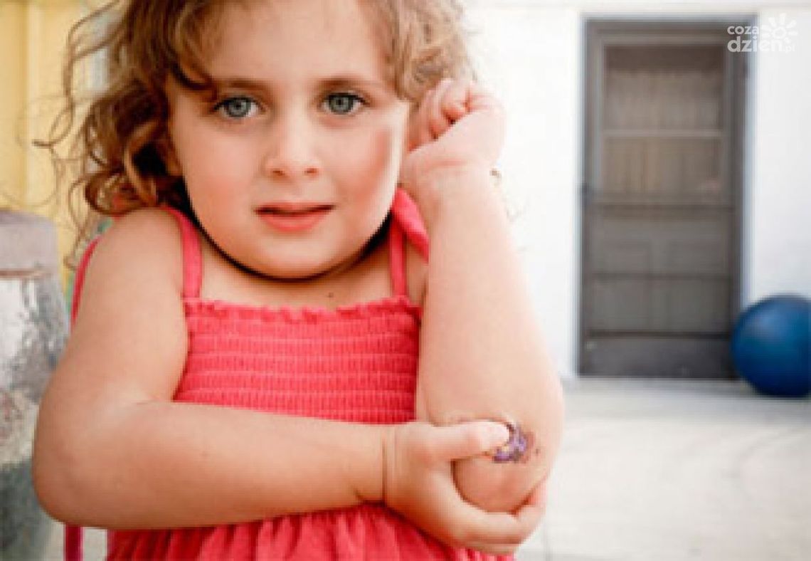 Skąd mam tyle siniaków?